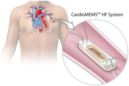 Cardiomems Net Worth